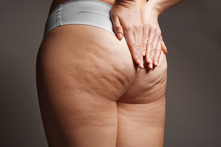 What exactly is cellulite?