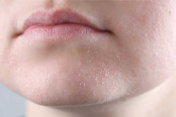 Sensitive skin or sensitized skin? What's the difference? – YUNASENCE