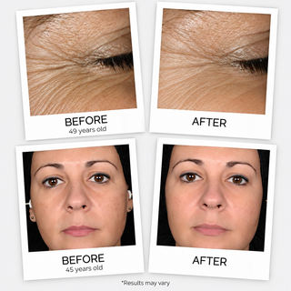 A four-panel before-and-after comparison showing a woman's face and skin texture, with close-up panels labeled BEFORE and AFTER and text noting 49 and 55 years old. Small text at the bottom says results may vary.
